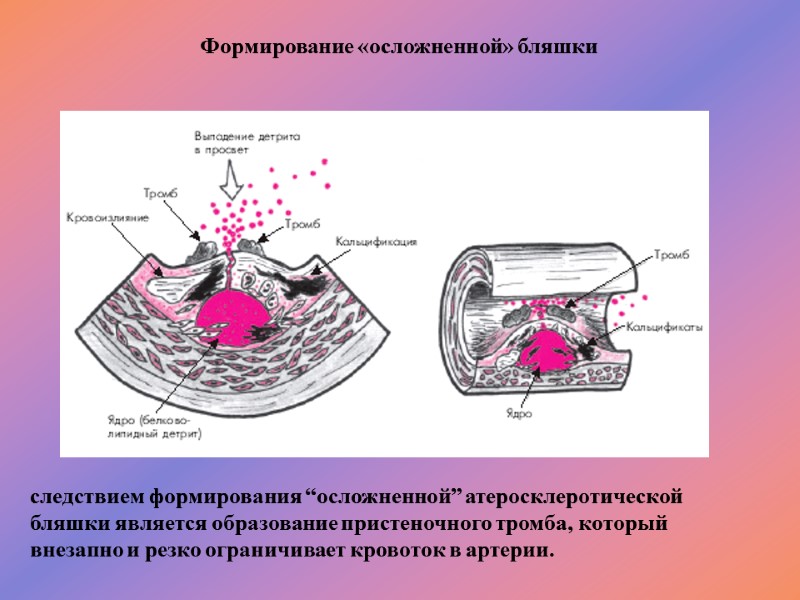 Формирование «осложненной» бляшки  следствием формирования “осложненной” атеросклеротической бляшки является образование пристеночного тромба, который